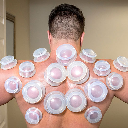 Cupping therapy at Strong Spine and Body