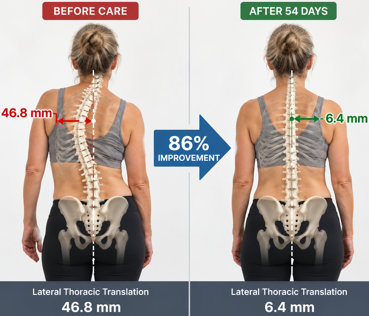 Illustration showing lateral thoracic translation improving from 46.8 mm to 6.4 mm after CBP corrective care